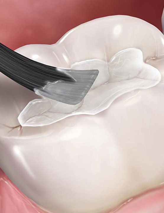 dental sealant application