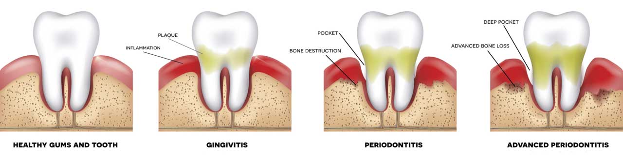 Gum Disease Progression