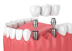Multiple Teeth Replacement Implants