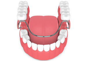 Partial Removable Dentures
