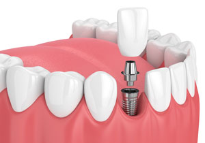 Single Tooth Replacement with Implant